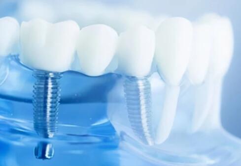 寧波做種植牙價格多少？更新2024年醫(yī)院排名