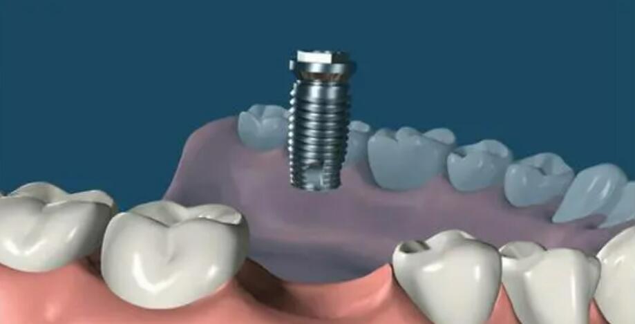 菏澤種牙多少錢一顆?以下三家都是口碑醫(yī)院現(xiàn)在下手還不晚