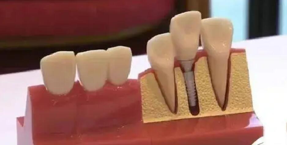 淄博做種植牙多少錢?優(yōu)秀口腔醫(yī)院與專家推薦