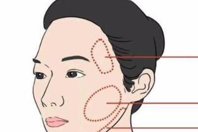 南寧自體脂肪面部填充價格是多少？附上相關(guān)價格標準