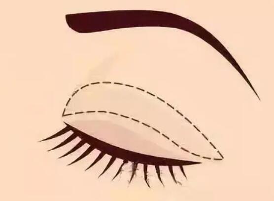 廈門雙眼皮價格多少錢？口碑醫(yī)院名單來襲