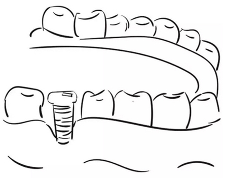 柳州做種植牙價格多少？價格咨詢附上，附三家醫(yī)院參考