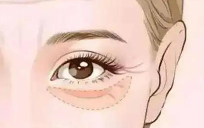 太原激光去眼袋要多少錢?寶藏醫(yī)美醫(yī)院攻略快收好