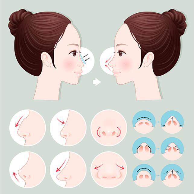 長沙隆鼻手術多少錢左右?實力醫(yī)美醫(yī)院一定要來看