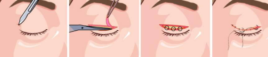 六安做雙眼皮手術(shù)多少錢?三大熱門口碑醫(yī)院推薦