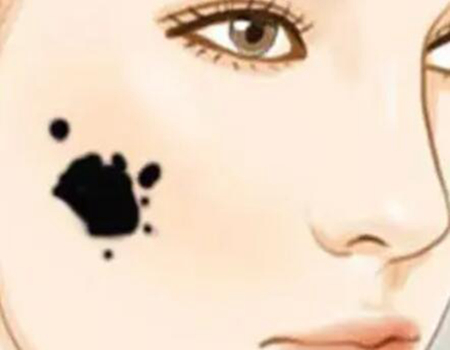 合肥做去胎記價(jià)格是多少？醫(yī)院名單和地址信息奉上