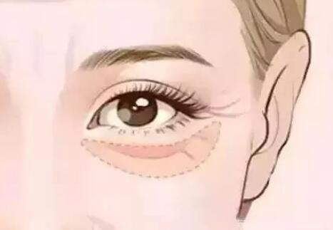 寧波祛眼袋多少錢？人氣醫(yī)院特別推薦