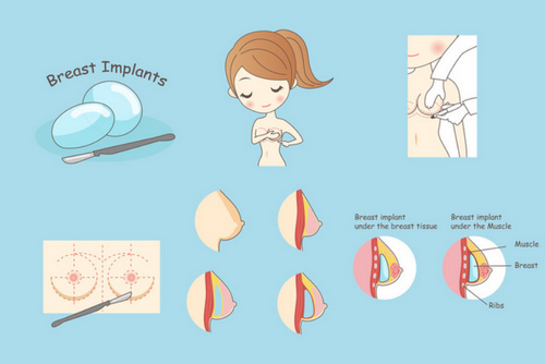 中日友好醫(yī)院整形科整胸效果如何？具體收費標(biāo)準(zhǔn)看這里