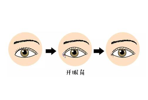 鄭州開眼角價格是多少？約3000元起，附醫(yī)院信息查收