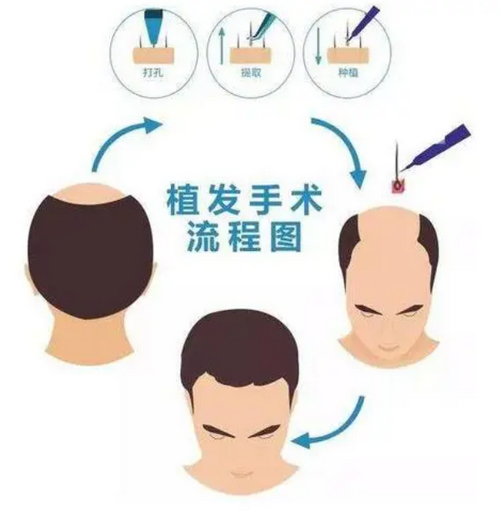 成都植發(fā)整形2024價格參考，內(nèi)附實力醫(yī)院推薦