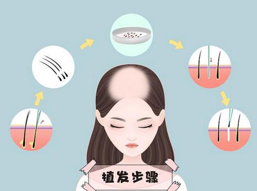 武漢植發(fā)整形怎么樣？內附實力醫(yī)院推薦+2024價格參考