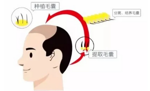 杭州植發(fā)整形2024價格參考，3家實力醫(yī)院信息分享