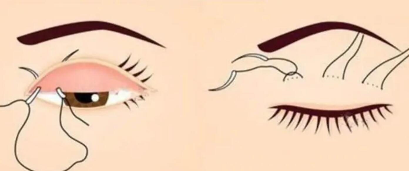 宜春做雙眼皮手術多少錢?三大人氣醫(yī)美醫(yī)院分享