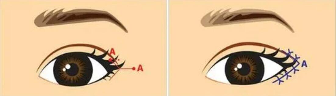 宜昌開眼角價格多少錢?三家人氣整形醫(yī)院在線