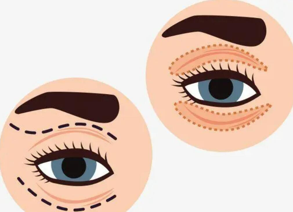 泰安割雙眼皮要花多少錢？都是實力整形醫(yī)院真的很難拒絕