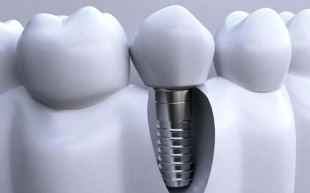 清遠種植牙一顆大概多少錢?詳細費用、醫(yī)院資料說明