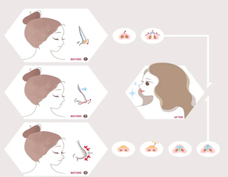 廣州隆鼻價格是多少？全新價格攻略，附醫(yī)院推薦