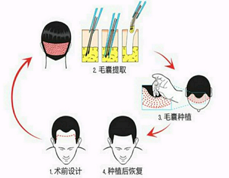 東莞植發(fā)發(fā)際線需要多少錢？人氣醫(yī)院來了\主打一個靠譜