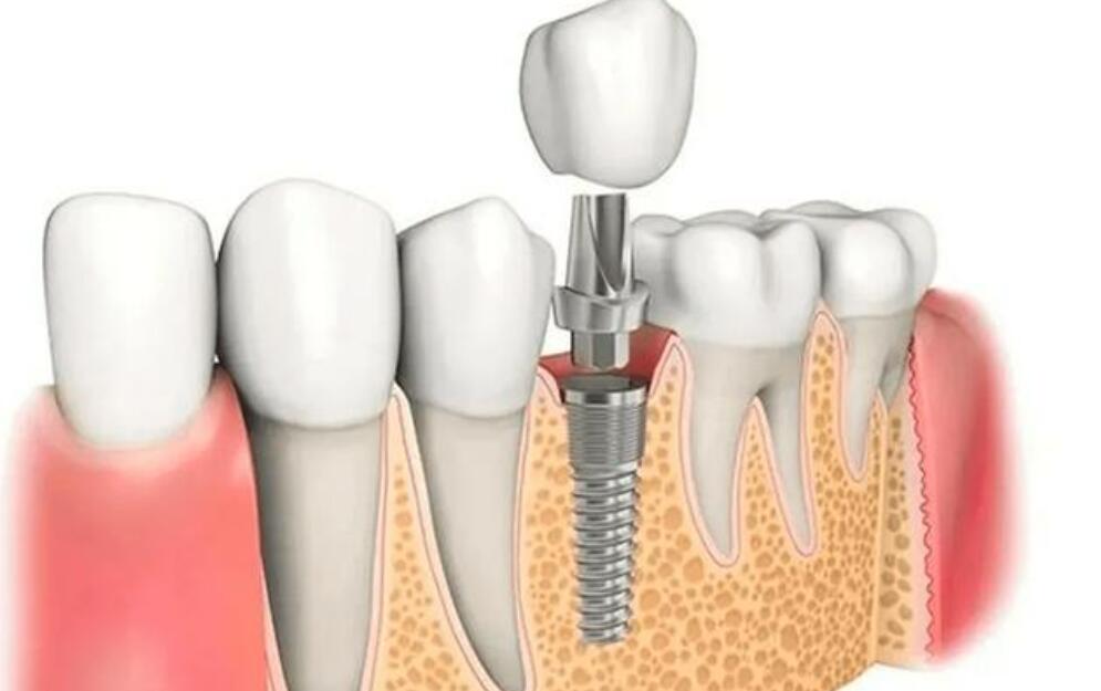 襄陽種牙大約多少錢?三家實力口腔醫(yī)院來啦！