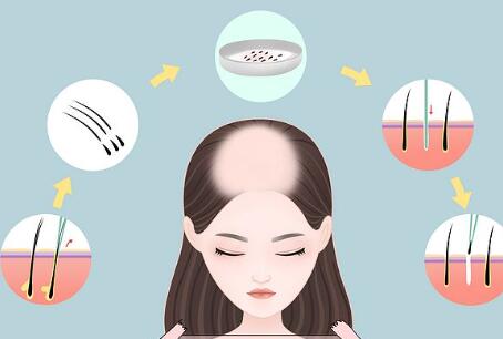 國內(nèi)植發(fā)多少錢？附上頭發(fā)種植醫(yī)院榜單