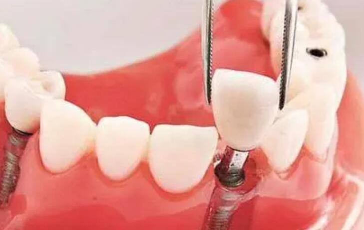 滁州種牙價格是多少?熱門口腔醫(yī)院直接閉眼入