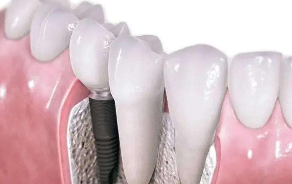 上饒牙齒種植多少錢?口碑種牙口腔醫(yī)院介紹