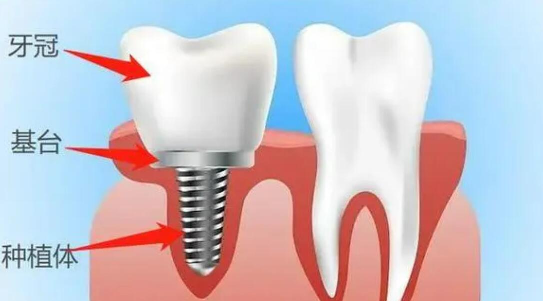 信陽種植牙多少錢一顆?實力口碑牙科醫(yī)院參考