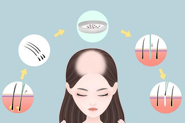 石家莊毛發(fā)種植多少錢？公立植發(fā)醫(yī)院云集