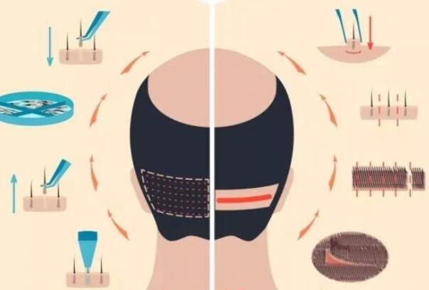 北京植發(fā)際線(xiàn)一般大約需要多少費(fèi)用？上榜均是高人氣機(jī)構(gòu)