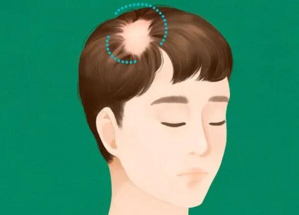 哈爾濱禿頭植發(fā)大概多少錢？全新頭發(fā)種植醫(yī)院名單來了