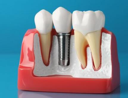 寧波做種植牙價格多少？醫(yī)院實力名單公布