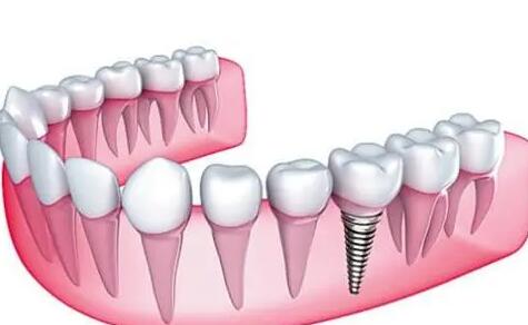 桂林種植牙價格多少？嚴選前三醫(yī)院排名