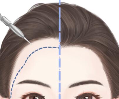 臨沂種植頭發(fā)大概需要多少錢？盤點(diǎn)口碑植發(fā)醫(yī)院+醫(yī)生參考