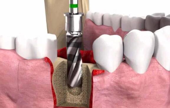 北京做種植牙價(jià)格多少？分享top3醫(yī)院榜單