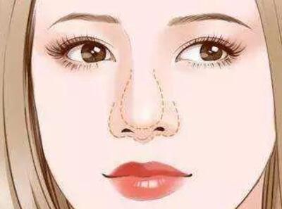 貴陽(yáng)自體脂肪隆鼻價(jià)格多少？匯總一份口碑醫(yī)院來(lái)了