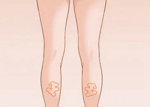 青島吸脂瘦腿多少錢？匯總?cè)覍?shí)力醫(yī)美醫(yī)院信息