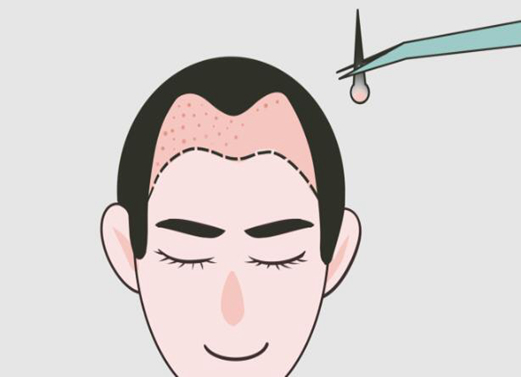 鄭州美人尖種植價格多少？這幾家實力口碑上榜