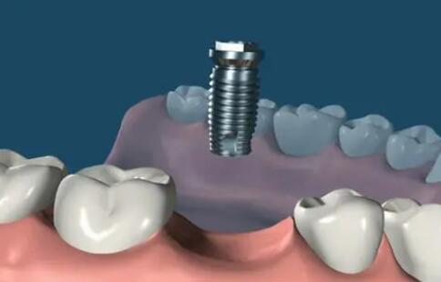 上海種植牙價(jià)格多少？前三醫(yī)院名單了解