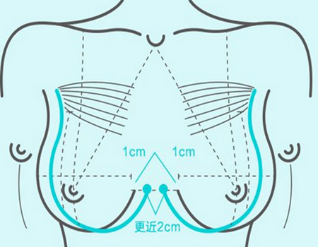 東莞隆胸醫(yī)院及費用是多少？口碑豐胸整形醫(yī)院推薦戳進來看