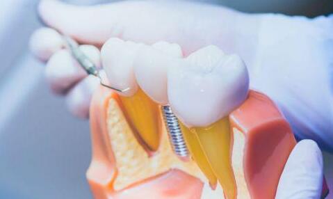 成都種植牙價格是多少？分享熱門醫(yī)院名單