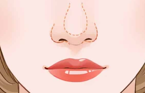 如何矯正朝天鼻