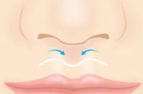 人中縮短術(shù)能改善凸嘴嗎